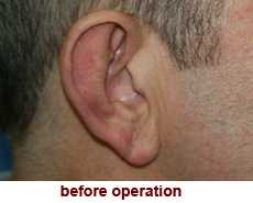 plastic-surgery-prominent-ear 